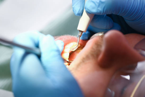 Best Emergency Dentist for Lost Fillings or Crowns in Abaster, AL